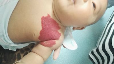 血管瘤精准诊疗