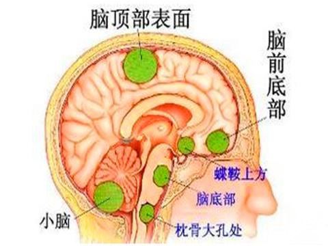 腦瘤手術後反覆發燒怎麼辦