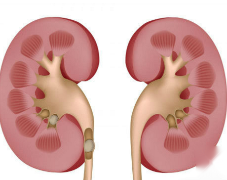 單純性腎囊腫易混淆疾病 什麼是單純性囊腎囊腫